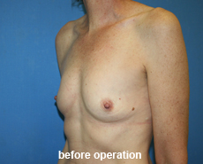 plastic-surgery-breast-augmentation